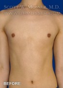 MTF Breast Augmentation Patient 58165 Before Photo Thumbnail # 1
