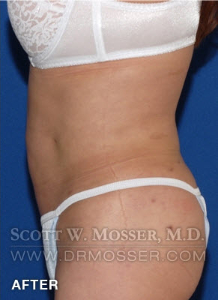 Body Contouring Patient 42004 After Photo # 10