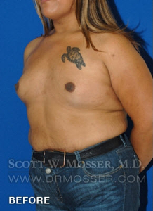 MTF Breast Augmentation Patient 18318 Before Photo # 5