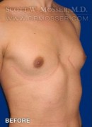 MTF Breast Augmentation Patient 69514 Before Photo Thumbnail # 5