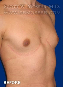 MTF Breast Augmentation Patient 69514 Before Photo # 5