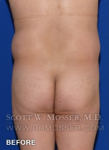 Body Contouring Patient 42004 Before Photo # 15
