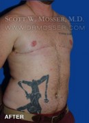 FTM Chest Reconstruction Patient 52629 After Photo Thumbnail # 4