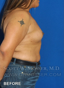 MTF Breast Augmentation Patient 18318 Before Photo # 7