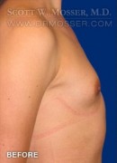 MTF Breast Augmentation Patient 69514 Before Photo Thumbnail # 3