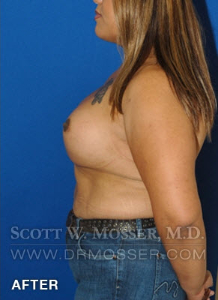 MTF Breast Augmentation Patient 18318 After Photo # 10