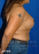 MTF Breast Augmentation Patient 18318 After Photo Thumbnail # 8
