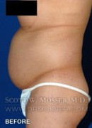 Body Contouring Patient 42004 Before Photo Thumbnail # 9