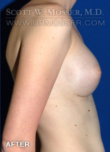 MTF Breast Augmentation Patient 73925 After Photo # 4