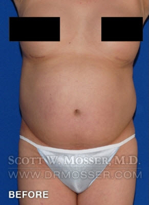 Body Contouring Patient 42004 Before Photo # 1