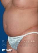 Body Contouring Patient 42004 Before Photo Thumbnail # 3