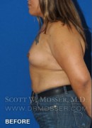 MTF Breast Augmentation Patient 18318 Before Photo Thumbnail # 9