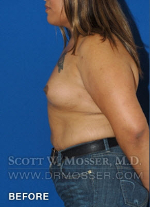 MTF Breast Augmentation Patient 18318 Before Photo # 9