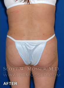 Body Contouring Patient 42004 After Photo # 16