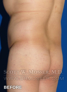 Body Contouring Patient 42004 Before Photo # 11