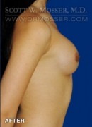 MTF Breast Augmentation Patient 58165 After Photo Thumbnail # 6