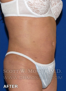 Body Contouring Patient 42004 After Photo # 6