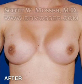 MTF Breast Augmentation Patient 69514 After Photo # 2